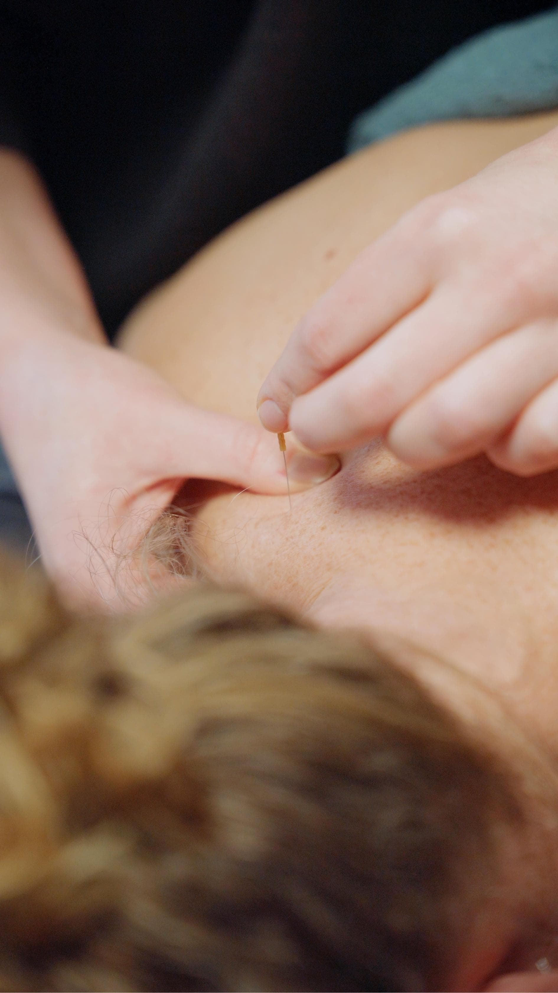 Dry needling bij Fysiotherapie Bilgaard